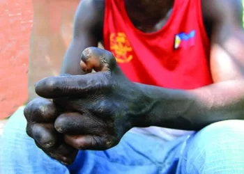 Angola regista mais de 700 casos de lepra em 2022