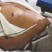 CETEP recebe mais de nove mil casos de tuberculose em um ano