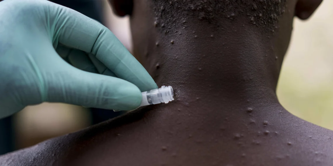 OMS reuniu comité de urgência para avaliar epidemia de Monkeypox em África