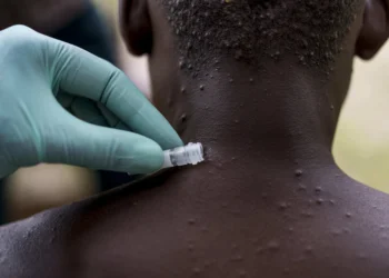 OMS reuniu comité de urgência para avaliar  epidemia de Monkeypox em África