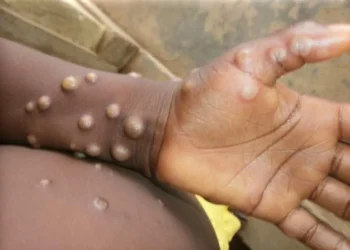 OMS diz que Costa do Marfim relatou casos de mpox Clade 2