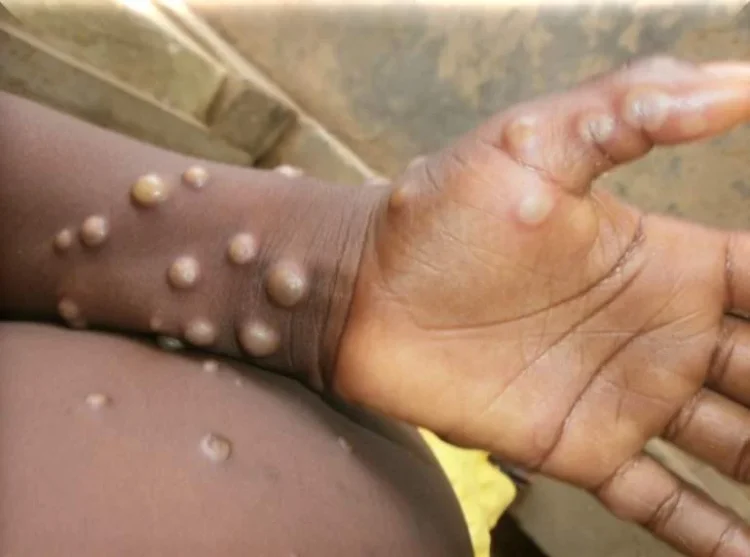 OMS diz que Costa do Marfim relatou casos de mpox Clade 2
