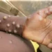 OMS diz que Costa do Marfim relatou casos de mpox Clade 2