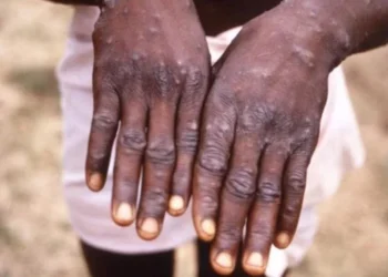 África regista mais de 22.800 casos  e 622 mortes por Mpox desde Janeiro
