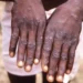 África regista mais de 22.800 casos e 622 mortes por Mpox desde Janeiro