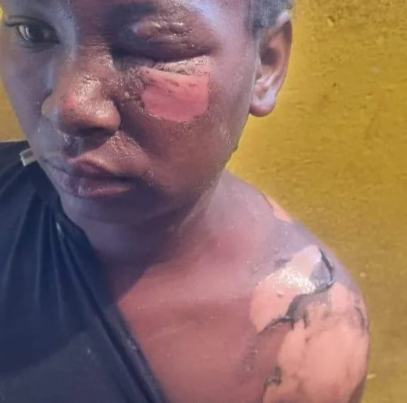 Mãe queima filha por extraviar a peruca no Namibe