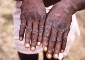 Zimbabwe relata os primeiros  dois casos de Mpox de variante não especificada