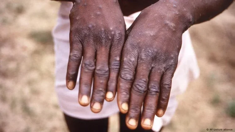 Zimbabwe relata os primeiros  dois casos de Mpox de variante não especificada