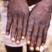 Zimbabwe relata os primeiros dois casos de Mpox de variante não especificada