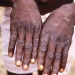 Nove países africanos vão receber 900 mil doses da vacina contra a varíola dos macacos
