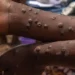 Casos confirmados de mpox em Moçambique provenientes do Malawi