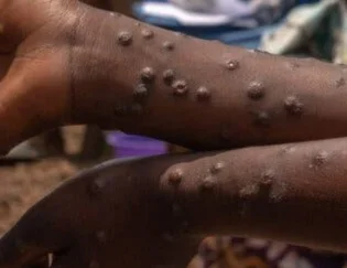 Casos confirmados de mpox em Moçambique provenientes do Malawi