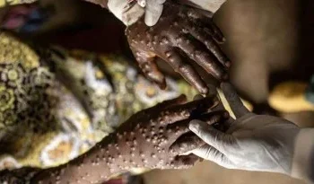 Confirmados mais sete casos de Mpox em Moçambique e 36 suspeitos