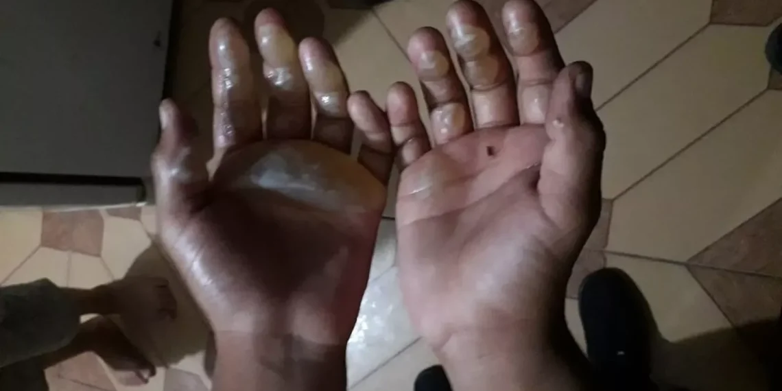 Mãe queima braços do filho de cinco anos por suposto roubo na panela da vizinha