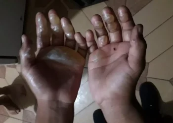 Mãe queima braços do filho de cinco anos por suposto roubo na panela da vizinha