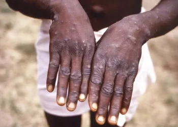Mais seis casos de mpox em Moçambique em 24 horas e 170 suspeitos