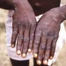 Mais seis casos de mpox em Moçambique em 24 horas e 170 suspeitos