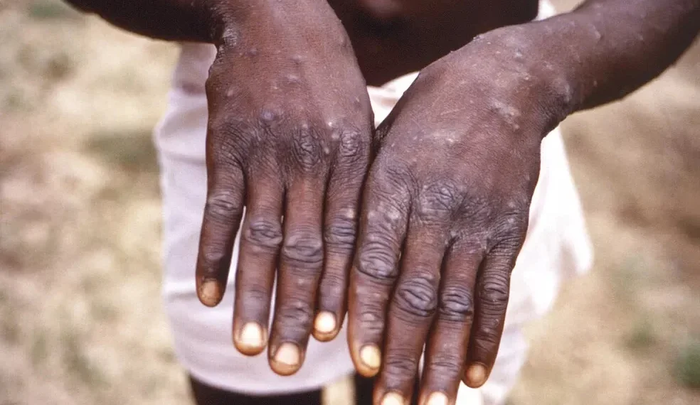 Mais seis casos de mpox em Moçambique em 24 horas e 170 suspeitos
