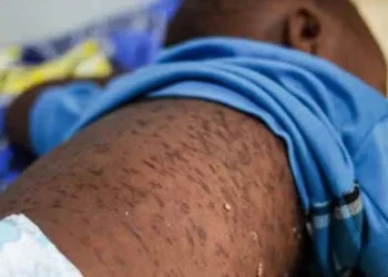 Zaire notifica 135 casos de sarampo em oito meses