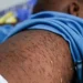 Zaire notifica 135 casos de sarampo em oito meses