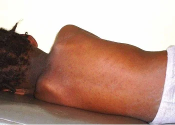 Surto de sarampo assola município de Buco-Zau em cabinda com registo mortal de cinco crianças