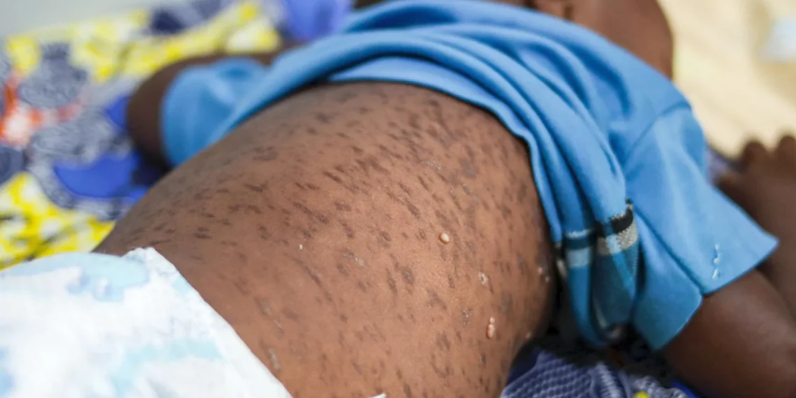 Surto de sarampo preocupa autoridades sanitárias em Cabinda