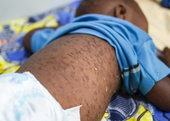 Surto de sarampo preocupa autoridades sanitárias em Cabinda