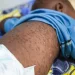 Surto de sarampo preocupa autoridades sanitárias em Cabinda