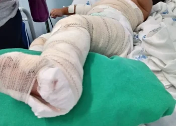 Mais de 100 crianças vítimas de queimaduras recebem cirurgia gratuita na Huíla