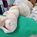 Mais de 100 crianças vítimas de queimaduras recebem cirurgia gratuita na Huíla