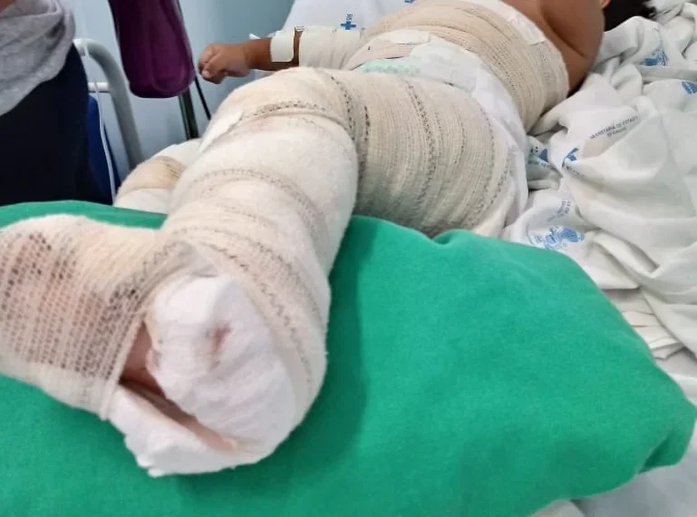 Mais de 100 crianças vítimas de queimaduras recebem cirurgia gratuita na Huíla