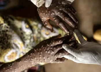 Moçambique com 89 casos de mpox em três meses