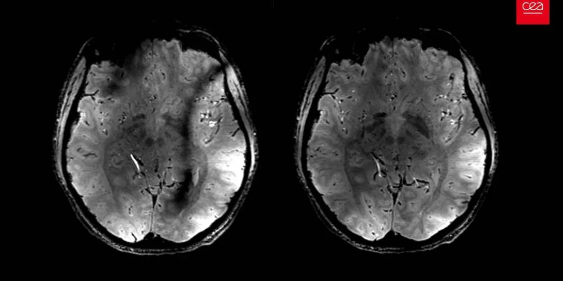 IA detecta primeiro marcador biológico de stress crónico em exames de imagem
