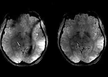 IA detecta primeiro marcador biológico de stress crónico em exames de imagem