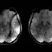 IA detecta primeiro marcador biológico de stress crónico em exames de imagem