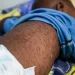 Mais de 1700 casos de sarampo registados no Luena em 2025