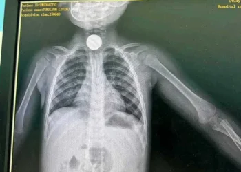 Hospital Geral da Lunda-Sul remove moeda da garganta de uma criança de seis anos