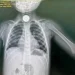 Hospital Geral da Lunda-Sul remove moeda da garganta de uma criança de seis anos