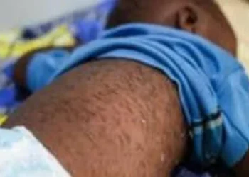 Cazombo regista mais de mil casos de sarampo e oito mortes