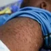 Cazombo regista mais de mil casos de sarampo e oito mortes