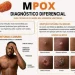 Angola regista 19 novos casos de Mpox nas últimas 24 horas