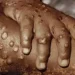 Cabinda regista primeiro caso de morte por Mpox
