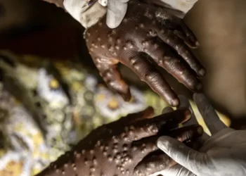 Angola contabiliza 92 casos activos de Mpox