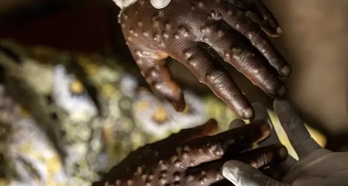Angola contabiliza 92 casos activos de Mpox