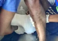 Jovem de 30 anos sofre ataque de jacaré durante travessia do rio Cuiva