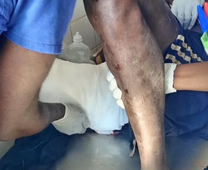 Jovem de 30 anos sofre ataque de jacaré durante travessia do rio Cuiva