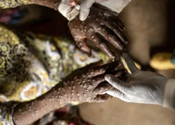 País regista quatro novos casos de Mpox nas últimas 24 horas