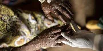 País regista quatro novos casos de Mpox nas últimas 24 horas